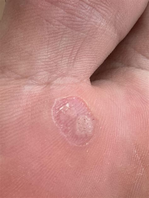 Have I removed warts? : r/Warts