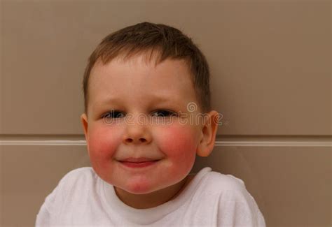 Toddler Allergy Rash