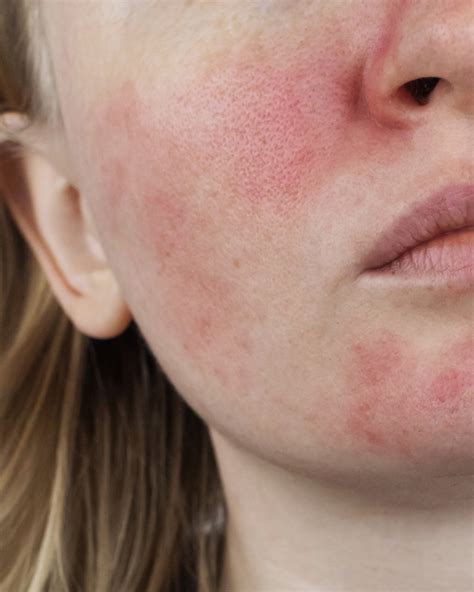 skin redness   wow facial
