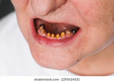 Toothless Mouth Dental Implants Prosthetics Implantation Stock Photo ...