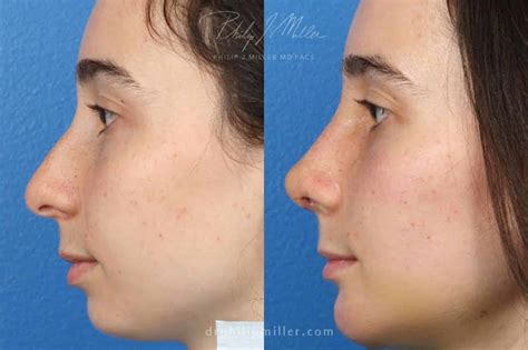 nose job cost