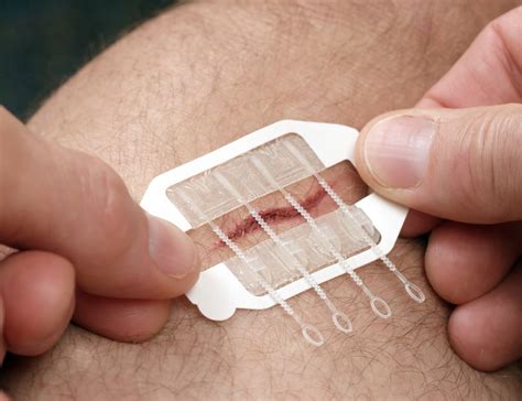 zipstitch   wound closure device  works  seconds