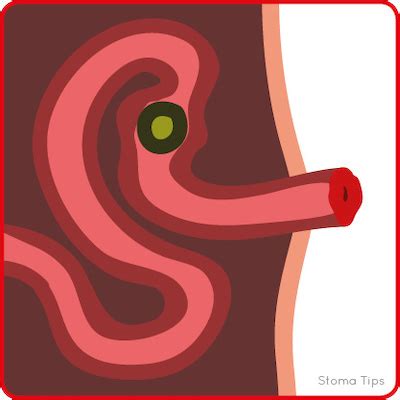 StomaTips - Troubleshooting your stoma