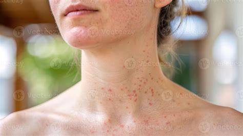 Atopic dermatitis neck rash woman skin irritation red spot allergy