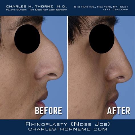 Before and after Rhinoplasty | Rhinoplasty, Face surgery, Nose surgery ...