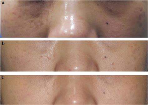 clinical pictures   subject  horis nevus  blue brown