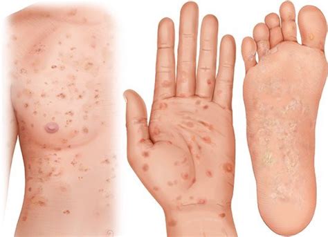 syphilis informedhealthorg