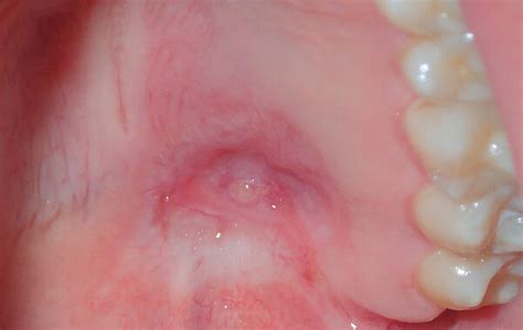 Schmerzlose Schwellung des Gaumens: Behandlungsalgorithmus und ...