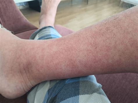 Parvovirus B19 Infection in Adults: A Case Series - PMC