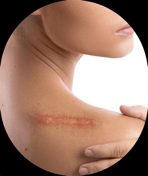 keloid treatment  skin secrets kochi