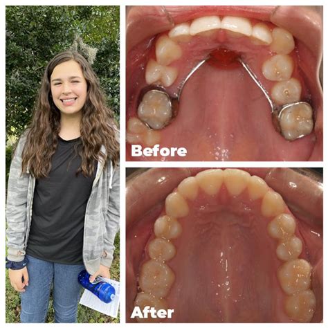 Palatal Expander Results