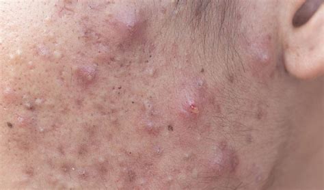 Understanding and Treating Cystic Acne