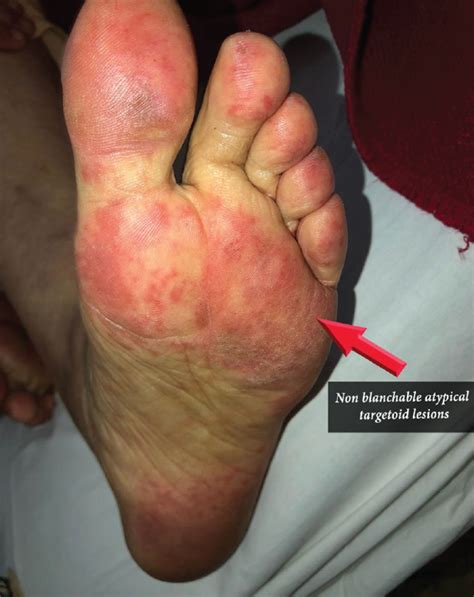 Joint Pain Feet Lupus at Pamela Beeler blog