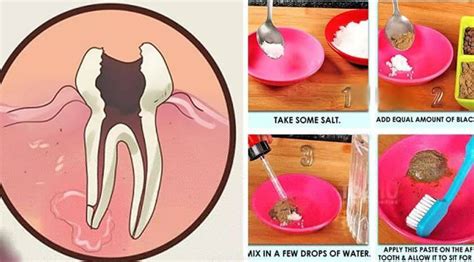 Quick Homemade Remedy For Toothache