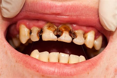 Cavity Between Teeth - Causes and Treatment Options | Aria Dental