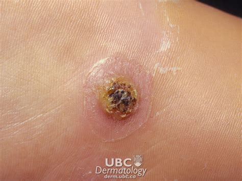 CSPA - Warts