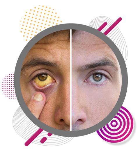 Jaundice Specialist in Chennai | Jaundice Care, Chennai