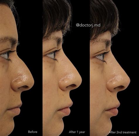 surgical rhinoplasty procedures vancouver  clinic md