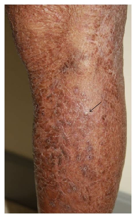 xerosis cutanea