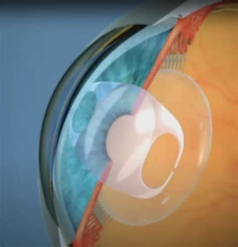 Toric ICL - Eye Hospital in Punjab