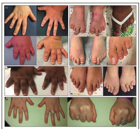 Brachydactyly In Chickens 6