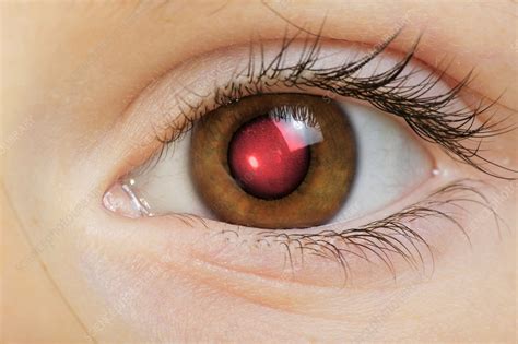 Camera flash red-eye - Stock Image - P420/0550 - Science Photo Library