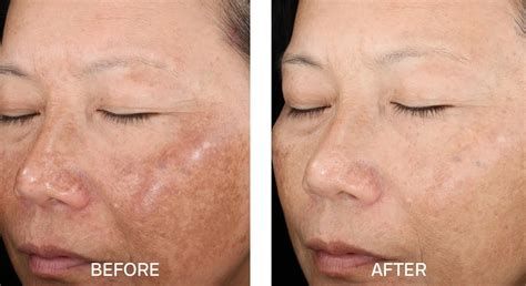 glycolic acid peel       park slope