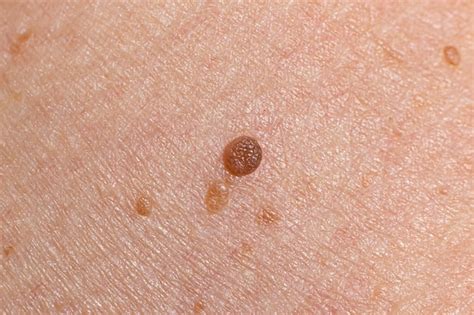 Premium Photo | Papilloma on human skin benign tumor in the form of mole