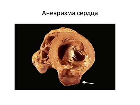 Ишемическая болезнь сердца - презентация онлайн
