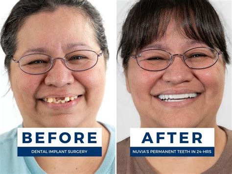 worst teeth