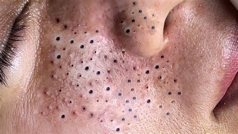 8 Unbelievable Blackhead Removal Tips You've Probably Never Heard Of (2024) - xryucg2