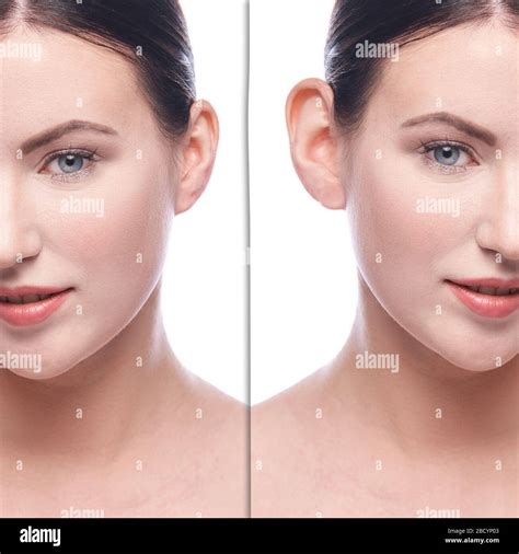 Girl before and after cosmetology plastic surgery Stock Photo - Alamy