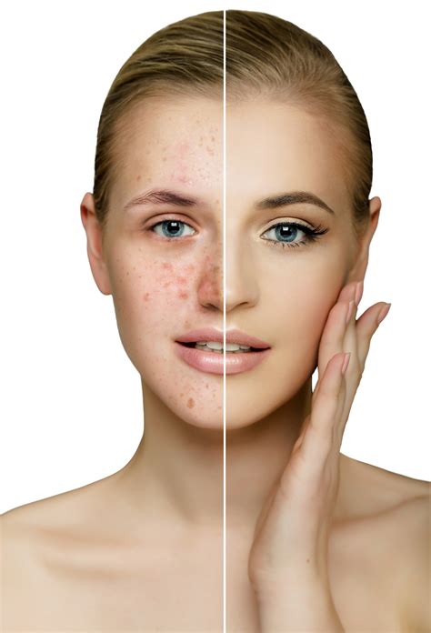 acne chemical face peel 12