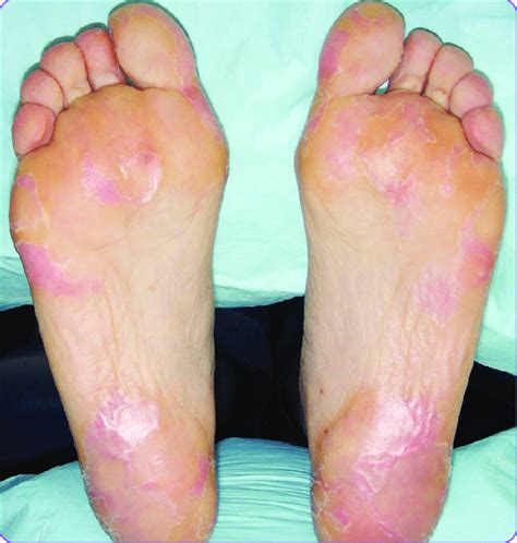 hand foot syndrome review  ebony heritage blog