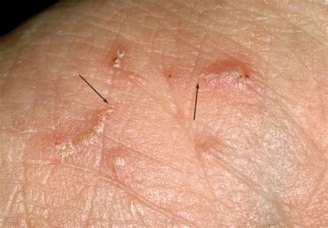 How Long Does Scabies Live Off The Body at Rene Salgado blog