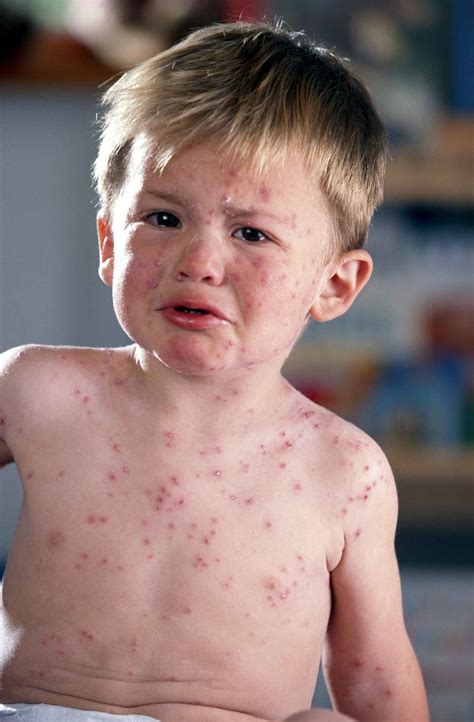 The Differences Between Acne & a Skin Rash on the Face | 2bstronger.com