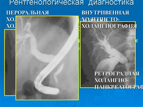 Желчнокаменная болезнь и ее осложнения - online presentation