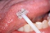 Brush Biopsy - Early Oral Cancer detection using Brush Biopsy or Oral ...