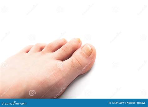 Damaged Toenail Isolated On White Background. Toenail Fungus. Stock ...