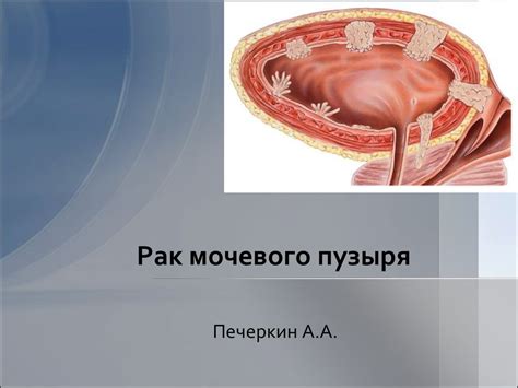 Рак мочевого пузыря - презентация онлайн