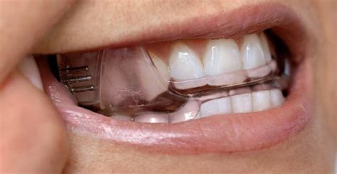 Sleep Apnea Dental Appliance Guide & FAQs | TMJ and Sleep