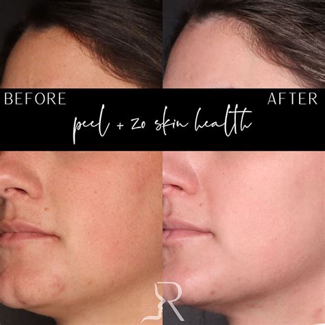 chemical peels results  houma la brian roberts md