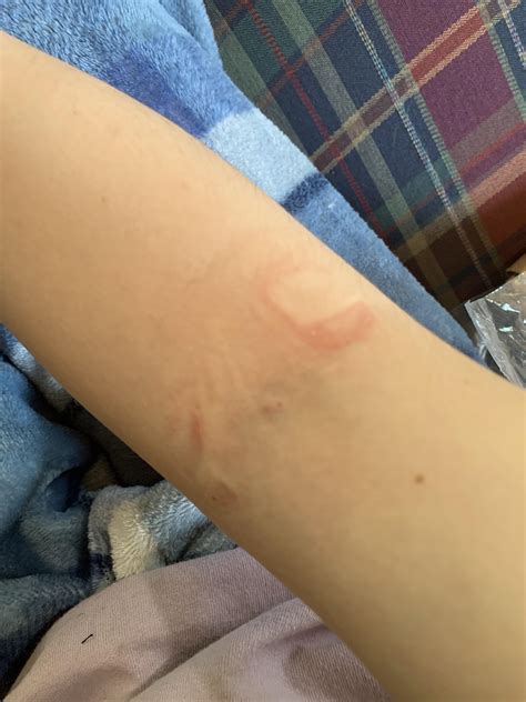 Can U Suddenly Become Allergic To Dogs