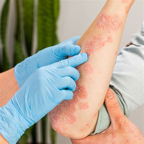 Vitamin D Deficiency Skin