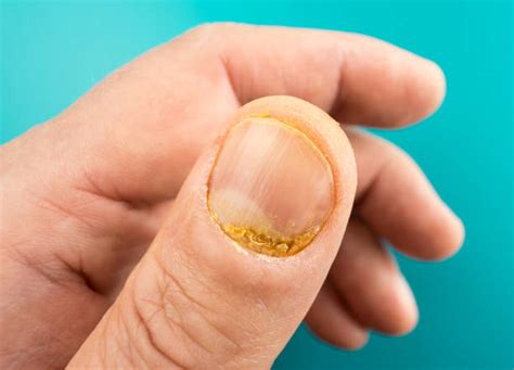 26.700+ Uñas Enfermas Fotografías de stock, fotos e imágenes libres de ...