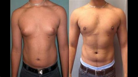 Gynecomastia Surgery can Change your Life - COOLWEBCAMAVATARS