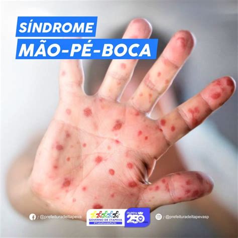 Doença Mao Pe E Boca Em Adulto - Doença Mão-Pé-Boca (HFMD) – Então Saúde