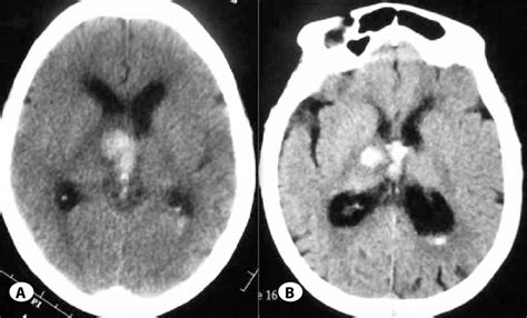 Non contrast CT scan of head showing right thalamic and IVH nine years ...