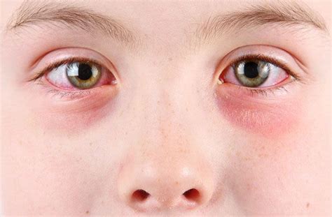 Gonorrhea Eye Treatment