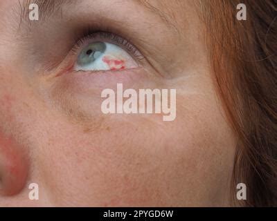 Subconjunctival hemorrhage or subconjunctival bleeding, hyposhagmus ...